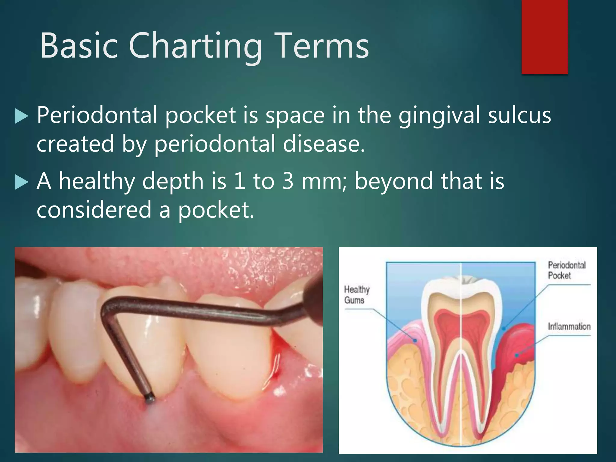 Basic Charting Terms
 Periodontal pocket is space in the gingival sulcus
created by periodontal disease.
 A healthy depth is 1 to 3 mm; beyond that is
considered a pocket.
 