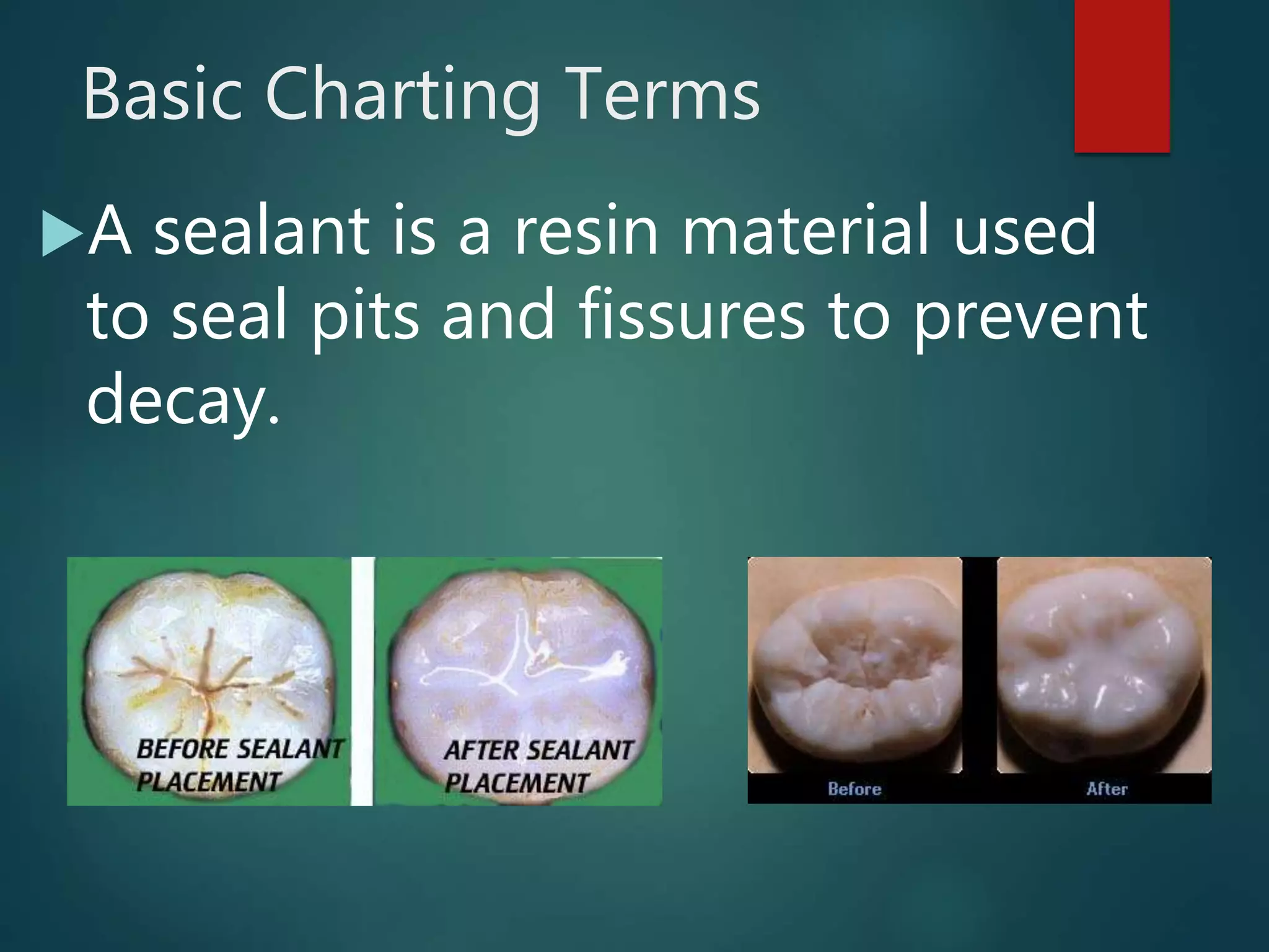 Basic Charting Terms
A sealant is a resin material used
to seal pits and fissures to prevent
decay.
 