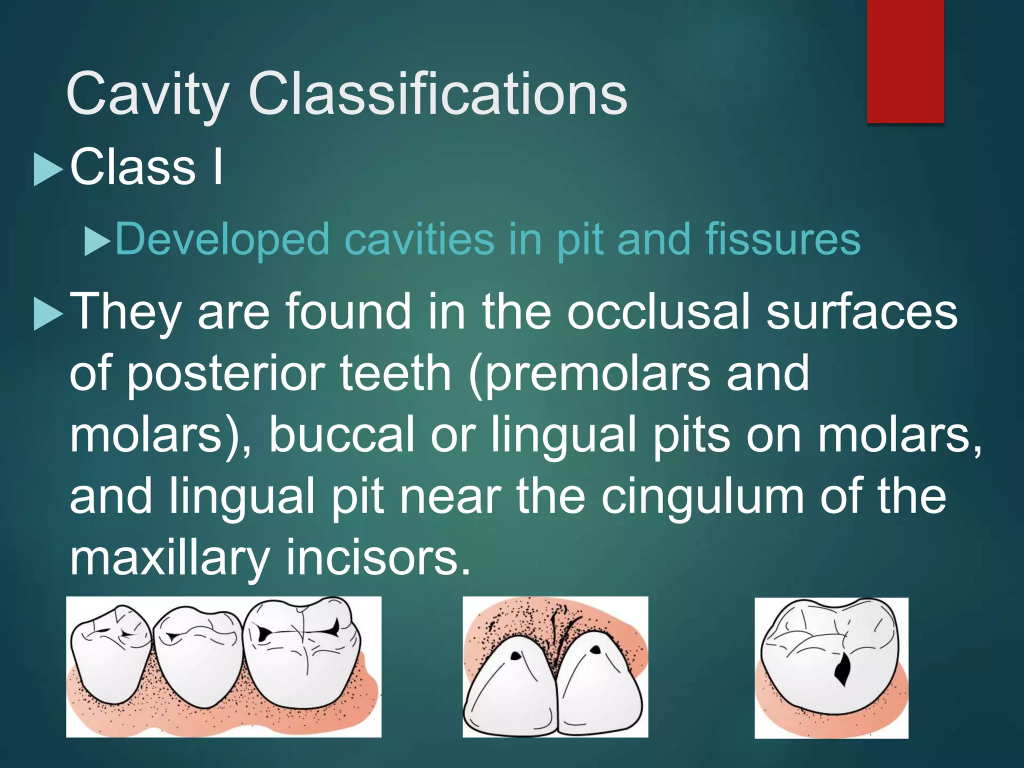 Cavity Classifications
Class I
Developed cavities in pit and fissures
They are found in the occlusal surfaces
of posterior teeth (premolars and
molars), buccal or lingual pits on molars,
and lingual pit near the cingulum of the
maxillary incisors.
 