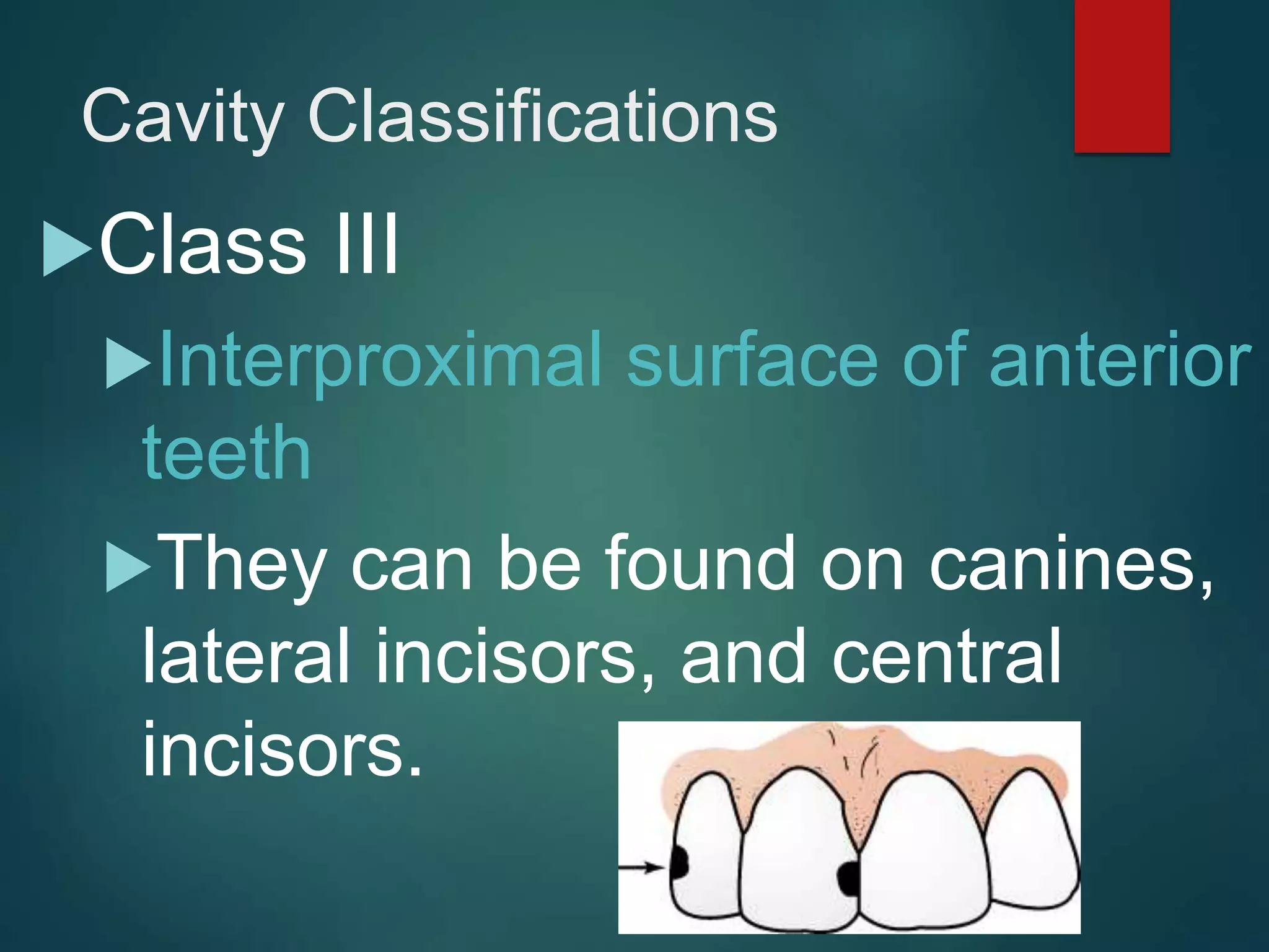 Cavity Classifications
Class III
Interproximal surface of anterior
teeth
They can be found on canines,
lateral incisors, and central
incisors.
 