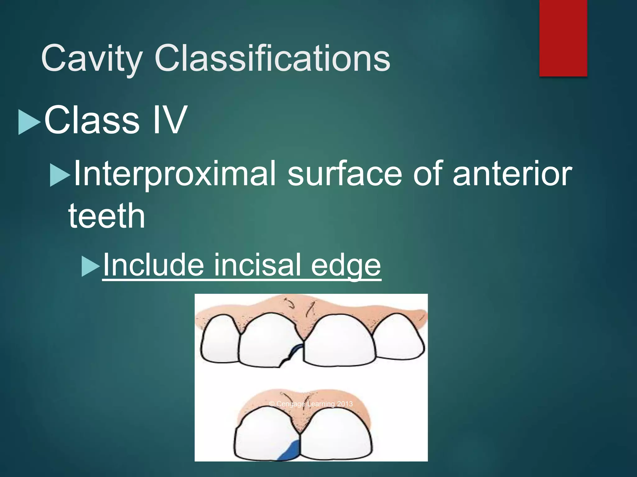 Dental charting Cavity Classification Basic Charting Terms PPTX