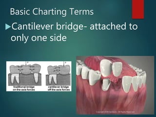 Basic Charting Terms
Cantilever bridge- attached to
only one side
 