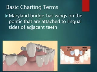 Basic Charting Terms
Maryland bridge-has wings on the
pontic that are attached to lingual
sides of adjacent teeth
 