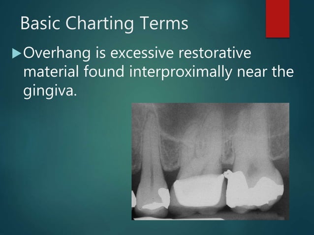 Dental charting, Cavity Classification, Basic Charting Terms | PPTX ...