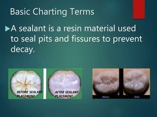 Basic Charting Terms
A sealant is a resin material used
to seal pits and fissures to prevent
decay.
 