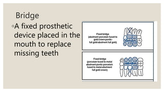 Bridge
◦A fixed prosthetic
device placed in the
mouth to replace
missing teeth
 