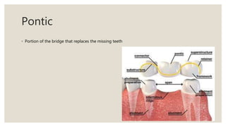 Pontic
◦ Portion of the bridge that replaces the missing teeth
 