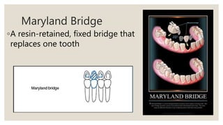 Maryland Bridge
◦A resin-retained, fixed bridge that
replaces one tooth
 