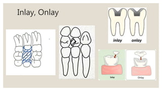 Inlay, Onlay
 