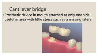 Cantilever bridge
◦Prosthetic device in mouth attached at only one side;
useful in area with little stress such as a missing lateral
 