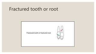 Fractured tooth or root
 