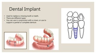 Dental Implant
• Used to replace a missing tooth or teeth.
• There are different types
• You can use in conjunction with a crown, or use to
support a partial or complete denture
 