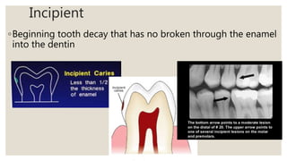 Incipient
◦Beginning tooth decay that has no broken through the enamel
into the dentin
 