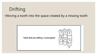 Drifting
◦Moving a tooth into the space created by a missing tooth
 