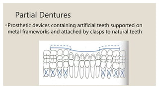 Partial Dentures
◦Prosthetic devices containing artificial teeth supported on
metal frameworks and attached by clasps to natural teeth
 
