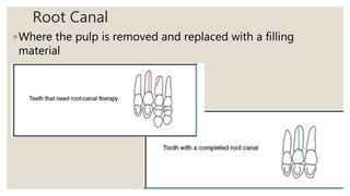 Root Canal
◦Where the pulp is removed and replaced with a filling
material
 