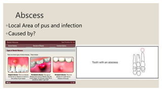 Abscess
◦Local Area of pus and infection
◦Caused by?
 