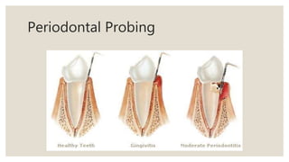 Periodontal Probing
 
