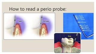 How to read a perio probe:
 
