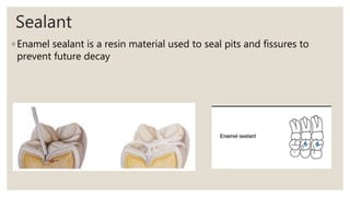 Sealant
◦ Enamel sealant is a resin material used to seal pits and fissures to
prevent future decay
 