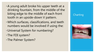 Charting
◦A young adult broke his upper teeth at a
drinking fountain, from the middle of the
biting edge to the middle of each front
tooth in an upside-down V pattern.
◦Which surfaces, classifications, and teeth
numbers would be involved if using the:
◦Universal System for numbering?
◦The FDI system?
◦The Palmer System?
 