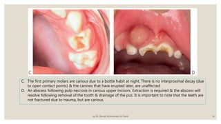 Eruption Abscess Dental cries | PPTX