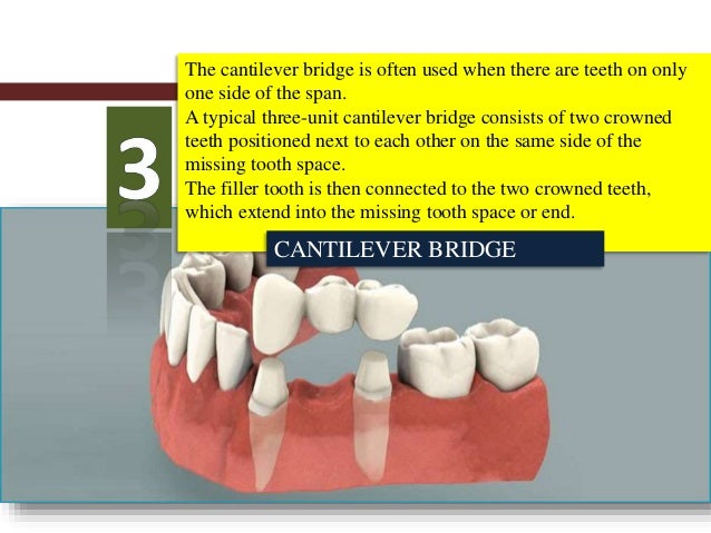 cantilever bridge dental