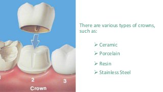 There are various types of crowns,
such as:
 Ceramic
 Porcelain
 Resin
 Stainless Steel
 