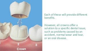 Each of these will provide different
benefits.
However, all crowns offer a
solution to a specific dental issue,
such as problems caused by an
accident, normal wear and tear,
or an oral disease.
 