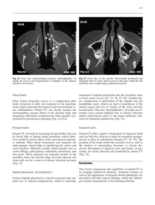 375
Sinus fistula
Sinus fistula frequently occurs as a complication after
tooth extraction or after root resection in the maxillary
molar region and must be treated to prevent maxillary si-
nus inflammation. Dental CT can clearly localize the
corresponding osseous defect in the alveolar ridge and
frequently orthoradial reconstructions offer optimal visu-
alization for preoperative planning (Fig. 12) [14].
Foreign bodies
Dental CT can help in localizing foreign bodies that can
be found after or during dental treatment, which other-
wise would be hard to detect with conventional radiolog-
ic methods. Most dental instruments and materials are
radio-opaque, which helps in identifying the source and
exact location. Materials usually found include root or
crown fillings, gutta-percha, endodontic instruments, and
root posts. These materials are typically located in the
maxillary sinus, the alveolar ridge, or in the adjacent soft
tissue and can be a source of chronic infection and pain
(Fig. 13).
Implant placement “periimplantitis”
Correct implant placement is crucial to prevent early im-
plant loss or clinical complications, which is especially
important if implant perforation into the maxillary sinus
or nasal cavity occurs [32, 33, 34, 35, 36]. Another ma-
jor complication is perforation of the implant into the
mandibular canal, which can lead to paresthesia of the
mental region and loss of vitality of the more mesially
located teeth. The term “periimplantitis” describes an os-
teolytic layer around implants due to chronic infection
and/or malocclusion and it is the major radiologic indi-
cator for imminent implant loss (Fig. 14).
Impacted teeth
Dental CT offers superb visualization of impacted teeth
and can help the clinician to plan his treatment preoper-
atively or prior to orthodontic therapy [37, 38, 39]. The
position of the tooth within the alveolar crest as well as
the relation to surrounding structures is clearly dis-
closed. Resorption of adjacent roots and hooks, in par-
ticular, are easily detected and quantified by dental CT
(Fig. 15).
Conclusion
This review summarizes the capabilities of dental CT as
an imaging method for dentistry. Anatomic features as
well as the appearance of frequent dental pathologies are
described with their typical findings, which the radiolo-
gist should communicate to the referring clinician.
Fig. 14 Axial slice demonstrating extensive “periimplantitis” in
region 26 (arrow) and misplacement of implants in the anterior
maxilla (arrowheads)
Fig. 15 Axial slice of the maxilla. Horizontally positioned and
impacted tooth 23 with a hook (arrow) at the apex within the left
maxillary sinus complicating a planned extraction
 
