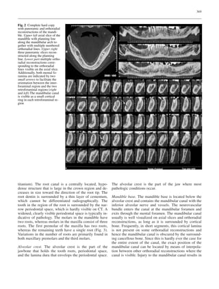 369
titanium). The root canal is a centrally located, hypo-
dense structure that is large in the crown region and de-
creases in size toward the direction of the root tip. The
root dentin is surrounded by a thin layer of cementum,
which cannot be differentiated radiographically. The
tooth in the region of the root is surrounded by the nar-
row periodontal space, which is hardly visible on CT. A
widened, clearly visible periodontal space is typically in-
dicative of pathology. The molars in the mandible have
two roots, whereas molars in the maxilla consist of three
roots. The first premolar of the maxilla has two roots,
whereas the remaining teeth have a single root (Fig. 3).
Variations in the number of roots are primarily found in
both maxillary premolars and the third molars.
Alveolar crest. The alveolar crest is the part of the
jawbone that holds the tooth roots, periodontal space,
and the lamina dura that envelops the periodontal space.
The alveolar crest is the part of the jaw where most
pathologic conditions occur.
Mandible base. The mandible base is located below the
alveolar crest and contains the mandibular canal with the
inferior alveolar nerve and vessels. The neurovascular
bundle enters the canal at the mandibular foramen and
exits through the mental foramen. The mandibular canal
usually is well visualized on axial slices and orthoradial
reconstructions, as long as it is surrounded by cortical
bone. Frequently, in short segments, this cortical lamina
is not present on some orthoradial reconstructions and
hence the mandibular canal is obscured by the surround-
ing cancellous bone. Since this is hardly ever the case for
the entire extent of the canal, the exact position of the
mandibular canal can be located by means of interpola-
tion between other orthoradial reconstructions where the
canal is visible. Injury to the mandibular canal results in
Fig. 2 Complete hard copy
with panoramic and orthoradial
reconstructions of the mandi-
ble. Upper left axial slice of the
mandible with planning line
along the mandibular arch to-
gether with multiple numbered
orthoradial lines. Upper right
three panoramic slices recon-
structed along the planning
line. Lower part multiple ortho-
radial reconstructions corre-
sponding to the orthoradial
lines visible on the axial slice.
Additionally, both mental fo-
ramina are indicated by two
small arrows to facilitate the
orientation between the inter-
foraminal region and the two
retroforaminal regions (right
and left) The mandibular canal
is visible as a small cortical
ring in each retroforaminal re-
gion
 