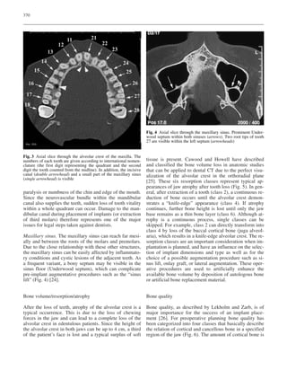 370
paralysis or numbness of the chin and edge of the mouth.
Since the neurovascular bundle within the mandibular
canal also supplies the teeth, sudden loss of tooth vitality
within a whole quadrant can occur. Damage to the man-
dibular canal during placement of implants (or extraction
of third molars) therefore represents one of the major
issues for legal steps taken against dentists.
Maxillary sinus. The maxillary sinus can reach far mesi-
ally and between the roots of the molars and premolars.
Due to the close relationship with these other structures,
the maxillary sinus can be easily affected by inflammato-
ry conditions and cystic lesions of the adjacent teeth. As
a frequent variant, a bony septum may be visible in the
sinus floor (Underwood septum), which can complicate
pre-implant augmentative procedures such as the “sinus
lift” (Fig. 4) [24].
Bone volume/resorption/atrophy
After the loss of teeth, atrophy of the alveolar crest is a
typical occurrence. This is due to the loss of chewing
forces in the jaw and can lead to a complete loss of the
alveolar crest in edentulous patients. Since the height of
the alveolar crest in both jaws can be up to 4 cm, a third
of the patient’s face is lost and a typical surplus of soft
tissue is present. Cawood and Howell have described
and classified the bone volume loss in anatomic studies
that can be applied to dental CT due to the perfect visu-
alization of the alveolar crest in the orthoradial plane
[25]. These six resorption classes represent typical ap-
pearances of jaw atrophy after tooth loss (Fig. 5). In gen-
eral, after extraction of a tooth (class 2), a continuous re-
duction of bone occurs until the alveolar crest demon-
strates a “knife-edge” appearance (class 4). If atrophy
continues, further bone height is lost until only the jaw
base remains as a thin bone layer (class 6). Although at-
rophy is a continuous process, single classes can be
skipped. For example, class 2 can directly transform into
class 4 by loss of the buccal cortical bone (juga alveol-
aria), which results in a knife-edge alveolar crest. The re-
sorption classes are an important consideration when im-
plantation is planned, and have an influence on the selec-
tion of implant dimensions and type as well as for the
choice of a possible augmentation procedure such as si-
nus lift, onlay graft, or lateral augmentation. These oper-
ative procedures are used to artificially enhance the
available bone volume by deposition of autologous bone
or artificial bone replacement material.
Bone quality
Bone quality, as described by Lekholm and Zarb, is of
major importance for the success of an implant place-
ment [26]. For preoperative planning bone quality has
been categorized into four classes that basically describe
the relation of cortical and cancellous bone in a specified
region of the jaw (Fig. 6). The amount of cortical bone is
Fig. 3 Axial slice through the alveolar crest of the maxilla. The
numbers of each tooth are given according to international nomen-
clature (the first digit representing the quadrant and the second
digit the tooth counted from the midline). In addition, the incisive
canal (double arrowhead) and a small part of the maxillary sinus
(single arrowhead) is visible
Fig. 4 Axial slice through the maxillary sinus. Prominent Under-
wood septum within both sinuses (arrows). Two root tips of tooth
27 are visible within the left septum (arrowheads)
 