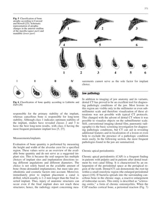 371
responsible for the primary stability of the implant,
whereas cancellous bone is responsible for long-term
stability. Although class 1 indicates optimum stability of
the implant, studies have revealed classes 2 and 3 to
have the best long-term results, with class 4 having the
most frequent premature implant loss [5, 27].
Measurements/implants
Evaluation of bone quantity is performed by measuring
the height and width of the alveolar crest for a specified
region. These values serve as an overview of the avail-
able bone quantity and do not serve as a suggested im-
plant size. This is because the oral surgeon has multiple
choices of implant sites and implantation directions us-
ing different angulations and different diameters. The
choice is not solely based on the available amount of
bone (bone-demanded implantation), but must take pro-
sthodontic and cosmetic factors into account. Moreover,
immediately prior to implant placement a canal is
drilled, which usually is 1–2 mm longer than the final in-
serted implant. Thus, injury of anatomic structures can
occur even if the final implant does not reach these
structures; hence, the radiology report concerning mea-
surements cannot serve as the sole factor for implant
choice.
Jaw pathology
In addition to imaging of jaw anatomy and its variants,
dental CT has proved to be an excellent tool for diagnos-
ing pathologic conditions of the jaw. Most lesions in
this region are visible only in the millimeter or even sub-
millimeter scale and therefore visualization of these al-
terations was not possible with typical CT protocols.
This changed with the advent of dental CT where it was
possible to visualize objects on the submillimeter scale.
Still, conventional imaging (dental film, panoramic radi-
ography) is the basic screening investigation for diagnos-
ing pathologic conditions, but CT can aid in revealing
additional features and in localization of a lesion or even
help to exclude the presence of a pathologic condition
more easily. In the following section, the most frequent
pathologies found in the jaw are summarized.
Chronic apical periodontitis
Chronic apical periodontitis (CAP) is a frequent finding
in patients with pulpitis and in patients after dental treat-
ment by root canal filling. It is characterized by an en-
largement of the periodontal space at the periapical re-
gion of the tooth. Dental CT can demonstrate the root tip
within a small osteolytic region (the enlarged periodontal
space) [16]. If bacteria spreads into the surrounding can-
cellous bone in the chronic stage, a reactive enlargement
of trabeculae occurs. This entity is described as “scleros-
ing ostitis,” a form of chronic osteomyelitis. When the
CAP reaches cortical bone, a periosteal reaction (Fig. 7)
Fig. 5 Classification of bone
atrophy according to Cawood
and Howell [25]. Schematic
representation of atrophic
changes in the anterior midline
of the maxilla (upper part) and
mandible (lower part)
Fig. 6 Classification of bone quality according to Lekholm and
Zarb [26]
 