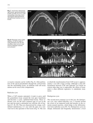 372
or reactive sinusitis can be visible (Fig. 8). After perfora-
tion of the apical periodontitis through the cortical bone
into the surrounding tissue, an infiltrate with soft tissue
edema can be seen in this compartment.
Radicular cysts
When a CAP remains untreated, it tends to grow until
the granulation tissue around the root apex transforms
and becomes a cystic, epithelial-lined lesion. These ra-
dicular cysts are the most common type of cyst in the
jaw and can reach a substantial size with the risk of frac-
ture [17, 28, 29]. They are characterized by a large, well-
defined radiolucency (>1 cm) with the apex of a non-
vital root in the epicenter of the lesion (Fig. 9). The size
at which the transformation from CAP occurs is approxi-
mately 1 cm with a large overlap. Although a clear dif-
ferentiation between CAP and radicular cyst based on
criteria other than size is impossible, the choice of treat-
ment is often different (operative vs endodontic treat-
ment).
Dentigerous cysts
The second most common cyst in the jaw, the dentiger-
ous cyst, also called follicular cyst, is located around
the crown of an impacted tooth and attaches to the ce-
mento-enamel junction, which helps in the differentia-
tion from radicular cysts [30, 31]. Dentigerous cysts are
sharply delineated and frequently demonstrate a local
Fig. 7 Axial slices demonstrat-
ing Chronic apical periodontitis
(CAP) of tooth 35 (arrow) with
surrounding sclerosing ostitis
and lingual-sided perforation
and periosteal reaction (arrow-
heads)
Fig. 8 Panoramic slices of the
maxilla. A CAP of tooth 27
with perforation into the left
maxillary sinus (arrows) and
reactive dentogen sinusitis
(arrowheads)
 