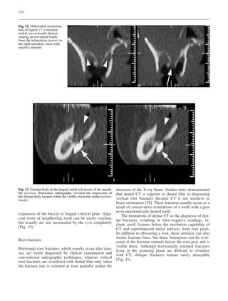 374
expansion of the buccal or lingual cortical plate. Adja-
cent roots of neighboring teeth can be easily reached,
but usually are not surrounded by the cyst completely
(Fig. 10).
Root fractures
Horizontal root fractures, which usually occur after trau-
ma, are easily diagnosed by clinical examination and
conventional radiographic techniques, whereas vertical
root fractures are visualized with dental film only when
the fracture line is oriented at least partially within the
direction of the X-ray beam. Studies have demonstrated
that dental CT is superior to dental film in diagnosing
vertical root fractures because CT is not sensitive to
beam orientation [19]. These fractures usually occur as a
result of conservative restorations of a tooth with a post
or in endodontically treated teeth.
The limitations of dental CT in the diagnosis of den-
tal fractures, resulting in false-negative readings, in-
clude small fissures below the resolution capability of
CT and superimposed metal artifacts from root posts.
In addition to obscuring a root, these artifacts can also
mimic fracture lines, but these limitations can be over-
come if the fracture extends below the root post and is
visible there. Although horizontally oriented fractures
lying in the scanning plane are difficult to visualize
with CT, oblique fractures remain easily detectable
(Fig. 11).
Fig. 12 Orthoradial reconstruc-
tion of region 17: extraction
socket (arrowheads) demon-
strating an oro-antral fistula
from the trifurcation (arrow) to
the right maxillary sinus with
reactive sinusitis
Fig. 13 Foreign body in the lingual-sided soft tissue of the mandi-
ble (arrows). Panoramic radiography revealed the impression of
the foreign body located within the visible extraction socket (arrow-
heads)
 