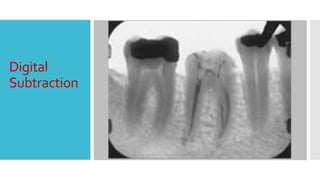 Dental digital radiography | PPTX