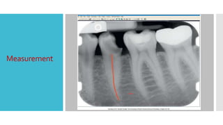 Dental digital radiography | PPTX