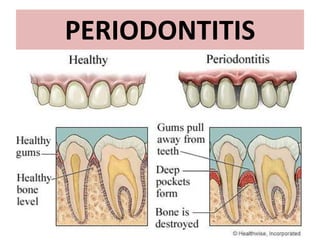 PERIODONTITIS

 