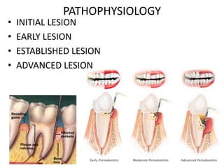 •
•
•
•

PATHOPHYSIOLOGY

INITIAL LESION
EARLY LESION
ESTABLISHED LESION
ADVANCED LESION

 