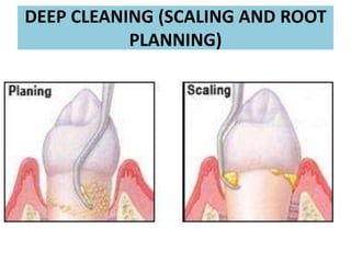 DEEP CLEANING (SCALING AND ROOT
PLANNING)

 