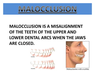 MALOCCLUSION IS A MISALIGNMENT
OF THE TEETH OF THE UPPER AND
LOWER DENTAL ARCS WHEN THE JAWS
ARE CLOSED.

 