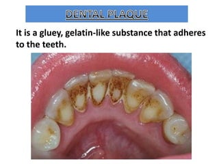 It is a gluey, gelatin-like substance that adheres
to the teeth.

 