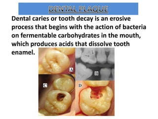 Dental caries or tooth decay is an erosive
process that begins with the action of bacteria
on fermentable carbohydrates in the mouth,
which produces acids that dissolve tooth
enamel.

 