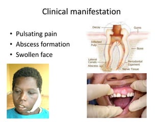 Clinical manifestation
• Pulsating pain
• Abscess formation
• Swollen face

 
