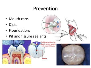 Prevention
•
•
•
•

Mouth care.
Diet.
Flouridation.
Pit and fissure sealants.

 