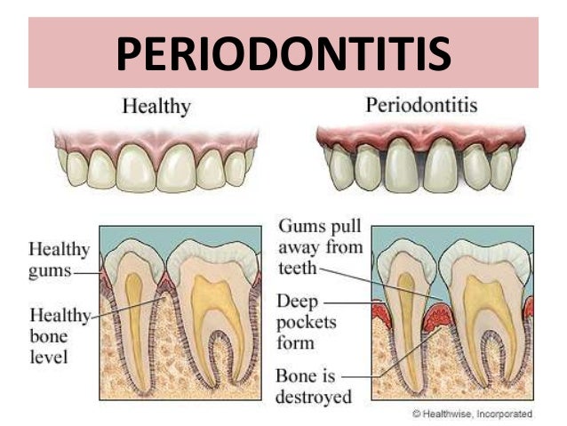 Dental disorders
