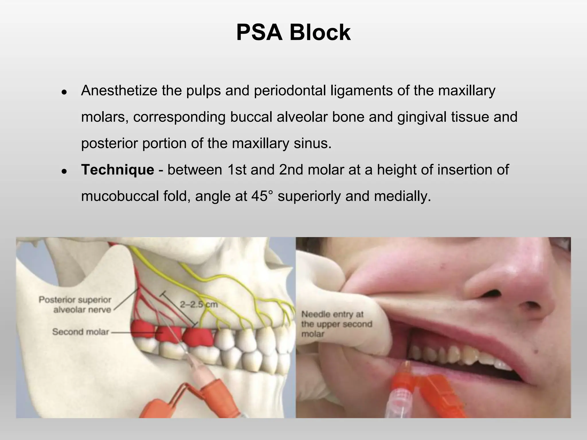 PSA Block
● Anesthetize the pulps and periodontal ligaments of the maxillary
molars, corresponding buccal alveolar bone and gingival tissue and
posterior portion of the maxillary sinus.
● Technique - between 1st and 2nd molar at a height of insertion of
mucobuccal fold, angle at 45° superiorly and medially.
 