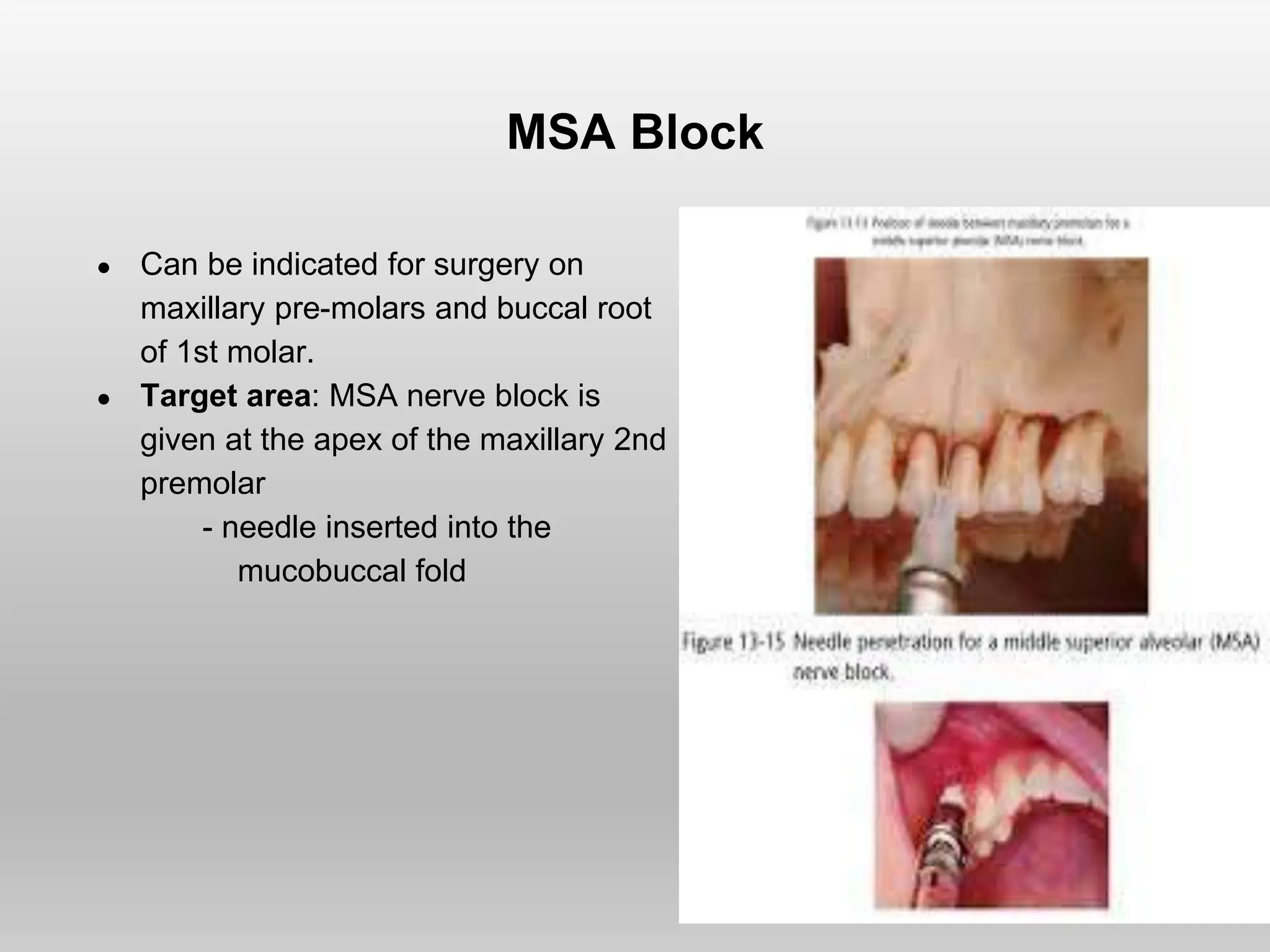 MSA Block
● Can be indicated for surgery on
maxillary pre-molars and buccal root
of 1st molar.
● Target area: MSA nerve block is
given at the apex of the maxillary 2nd
premolar
- needle inserted into the
mucobuccal fold
 