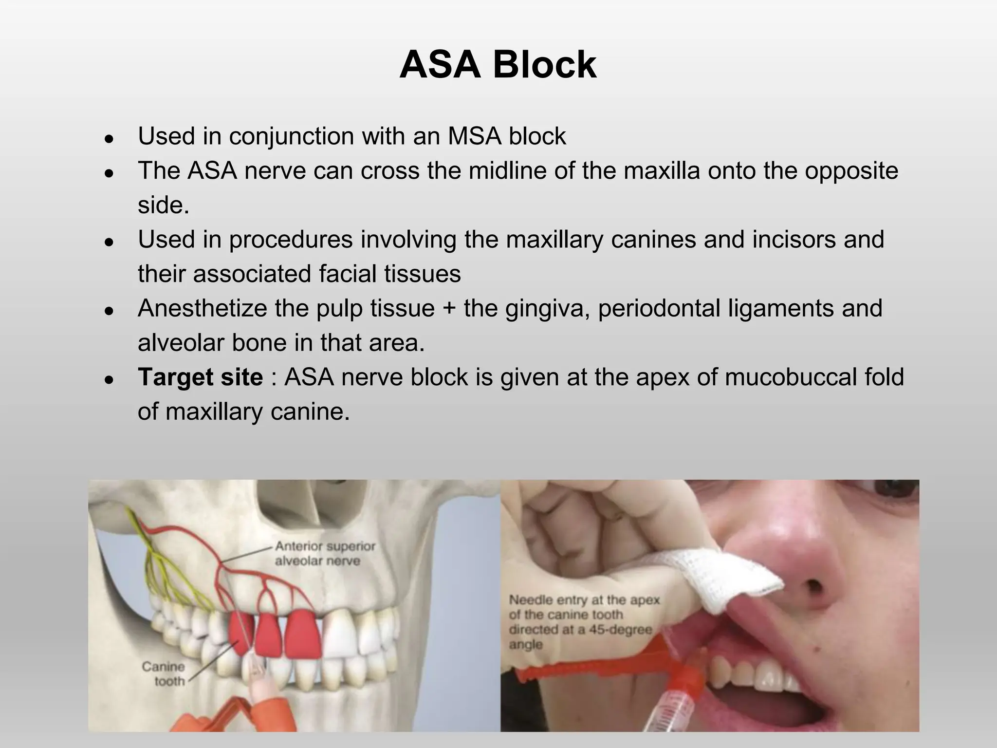 ASA Block
● Used in conjunction with an MSA block
● The ASA nerve can cross the midline of the maxilla onto the opposite
side.
● Used in procedures involving the maxillary canines and incisors and
their associated facial tissues
● Anesthetize the pulp tissue + the gingiva, periodontal ligaments and
alveolar bone in that area.
● Target site : ASA nerve block is given at the apex of mucobuccal fold
of maxillary canine.
 