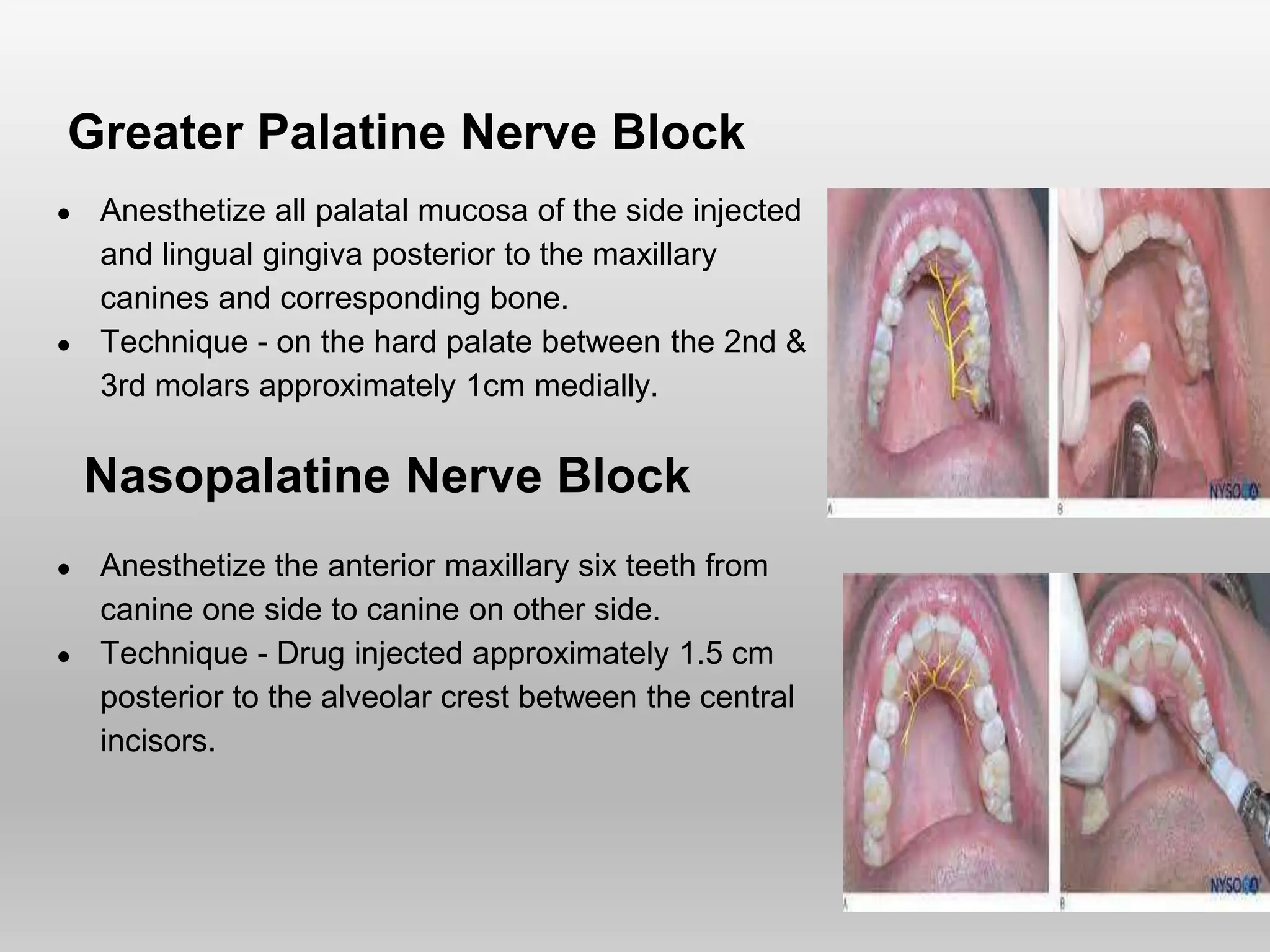 Greater Palatine Nerve Block
● Anesthetize all palatal mucosa of the side injected
and lingual gingiva posterior to the maxillary
canines and corresponding bone.
● Technique - on the hard palate between the 2nd &
3rd molars approximately 1cm medially.
Nasopalatine Nerve Block
● Anesthetize the anterior maxillary six teeth from
canine one side to canine on other side.
● Technique - Drug injected approximately 1.5 cm
posterior to the alveolar crest between the central
incisors.
 